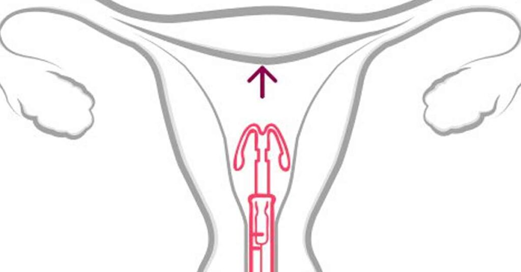 Como Funciona o DIU Mirena Mecanismos e Eficiência